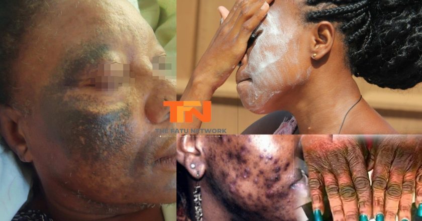Side Effects and Precautions of Skin Bleaching